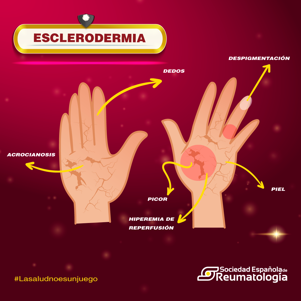 Desde la SER sumamos a la celebración 'Día Mundial la Esclerodermia' - SER